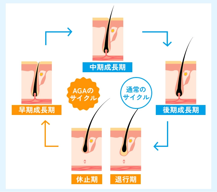 AGAを発症している方のヘアサイクル