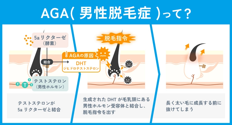 AGAが起こる仕組み