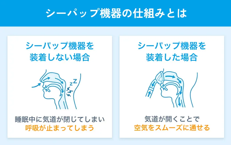 シーパップ機器の仕組みと症状が改善される理由