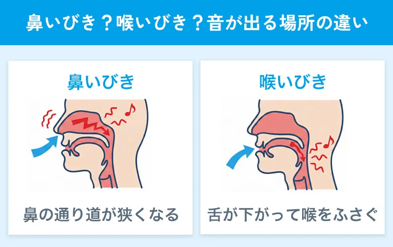 鼻いびきと喉いびきの違い