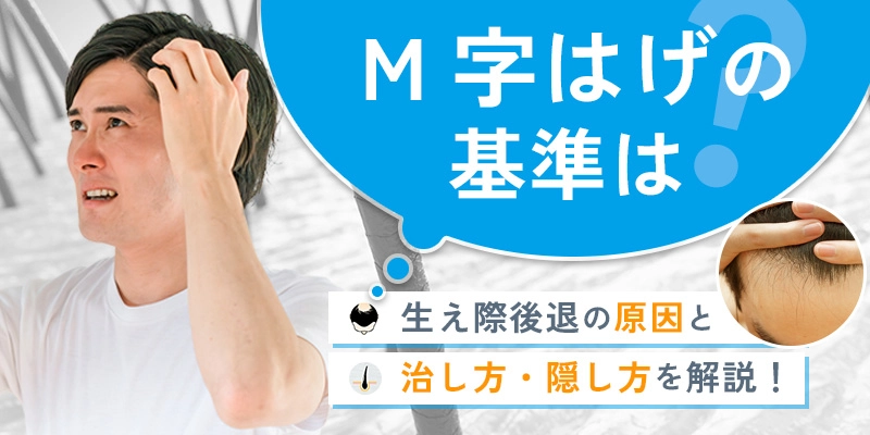 M字はげの基準はどこから？生え際後退の前兆や治し方・隠し方